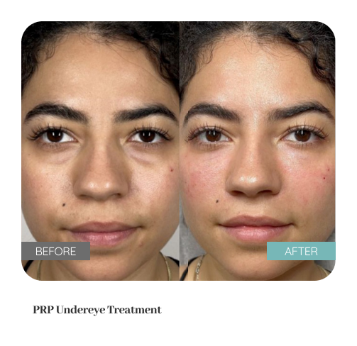 Before and after treatment result — Dr. Lanna, LC Medical Aesthetics NYC